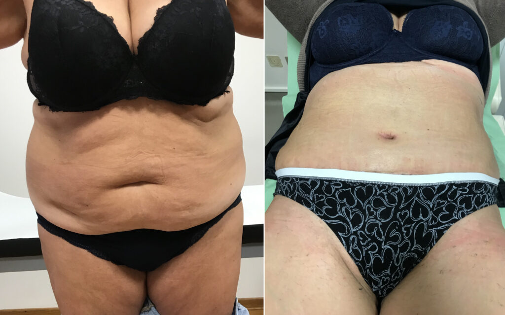 addominoplastica-testimonianze