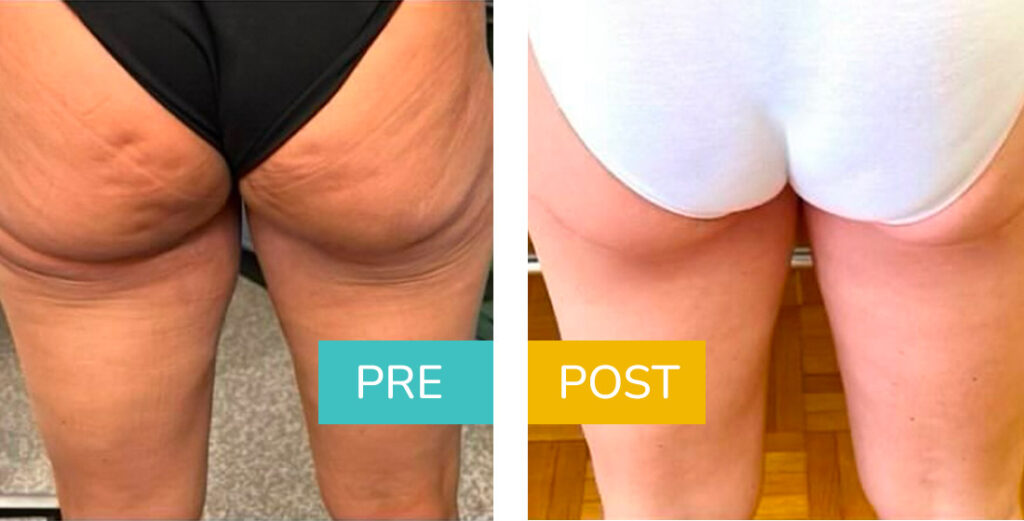 liposuzione-gambe
