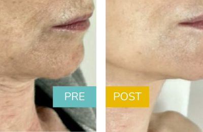 lifting-non-chirurgico-viso